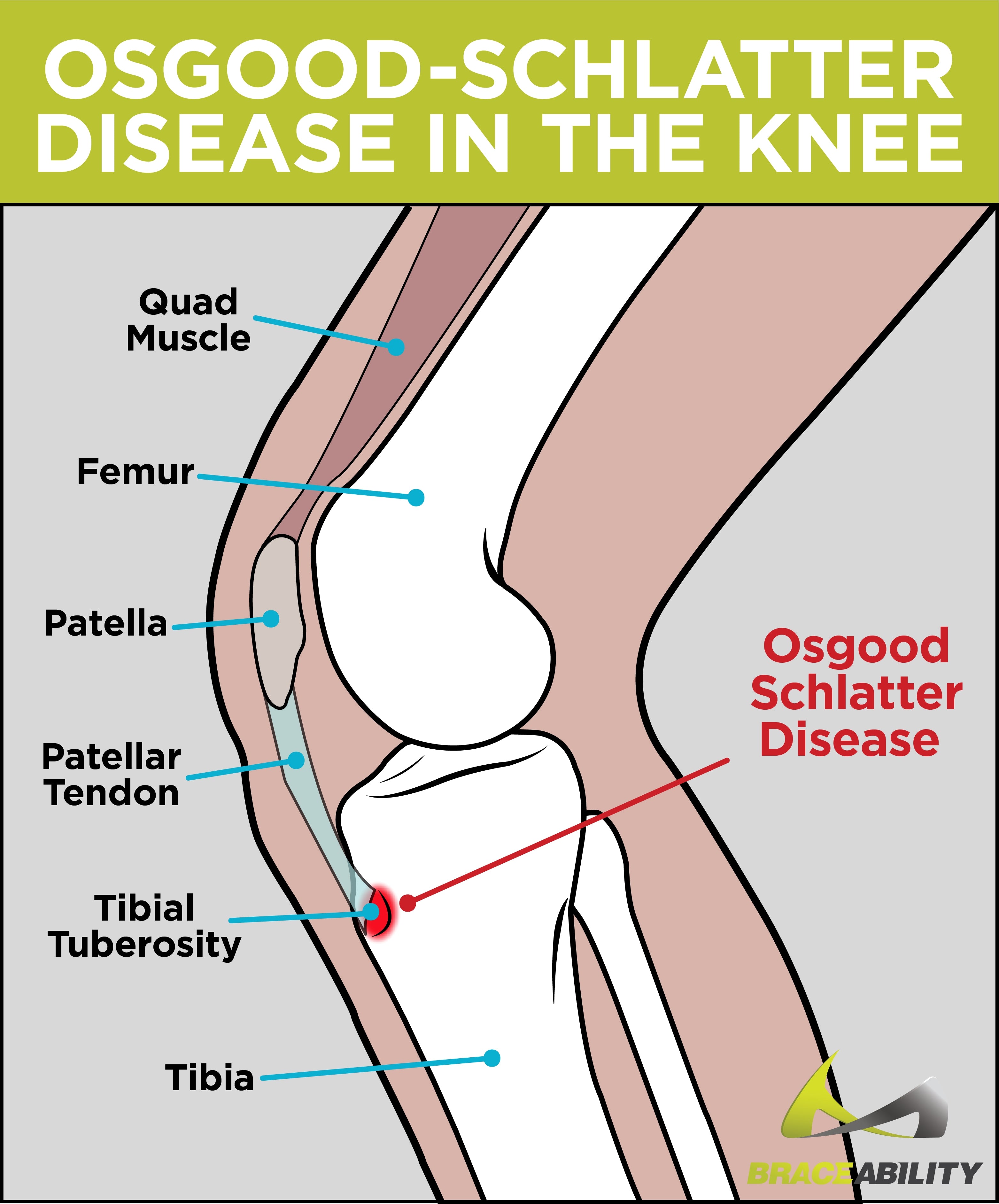 Treatment For Osgood Schlatter's Disease