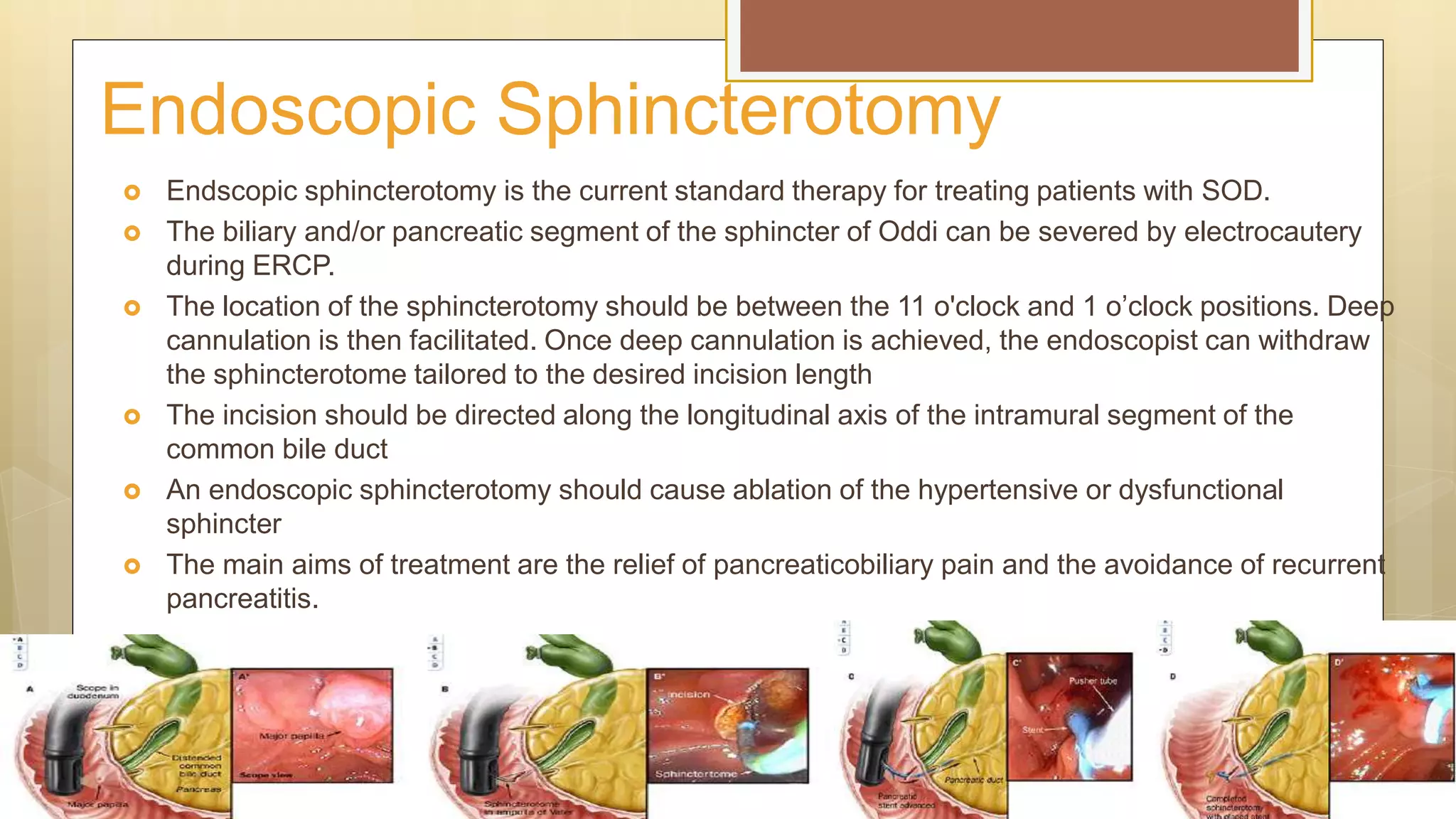 Treatment For Sphincter Of Oddi