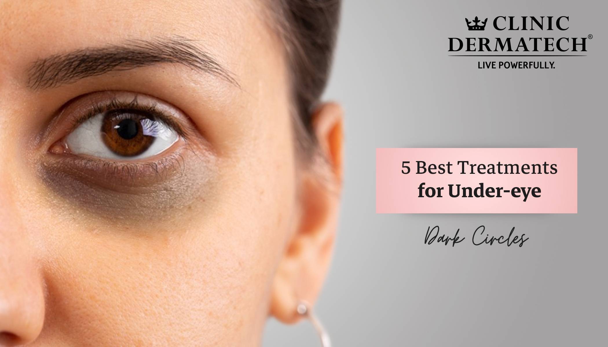 Treatment For Under Eye Dark Circles