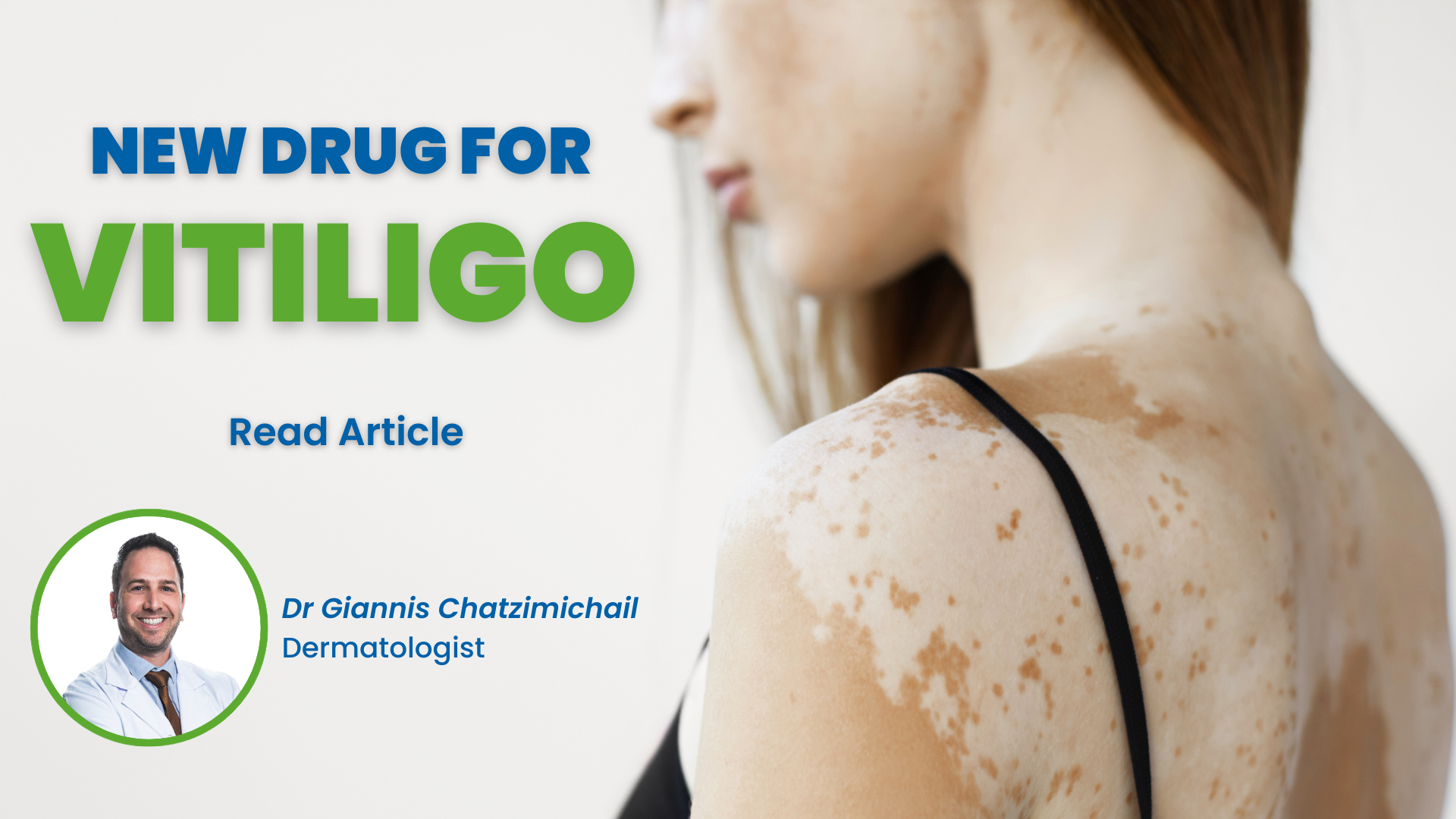 Treatment For Vitiligo