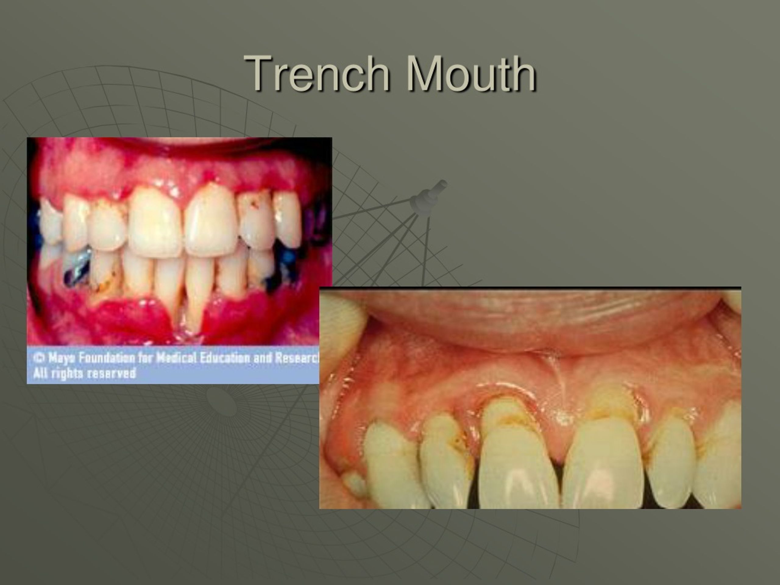 Trench Mouth Disease