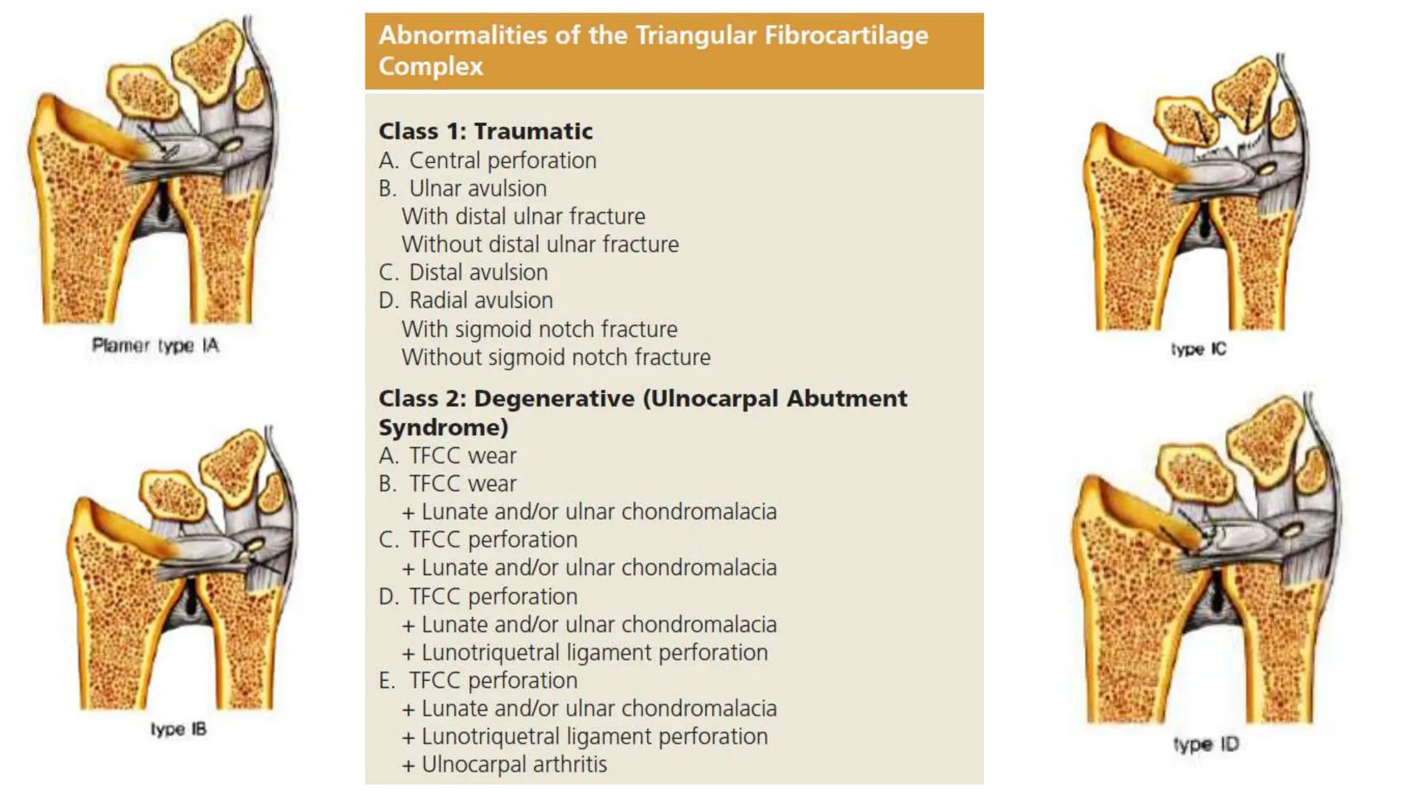 Triangular Cartilage Injury