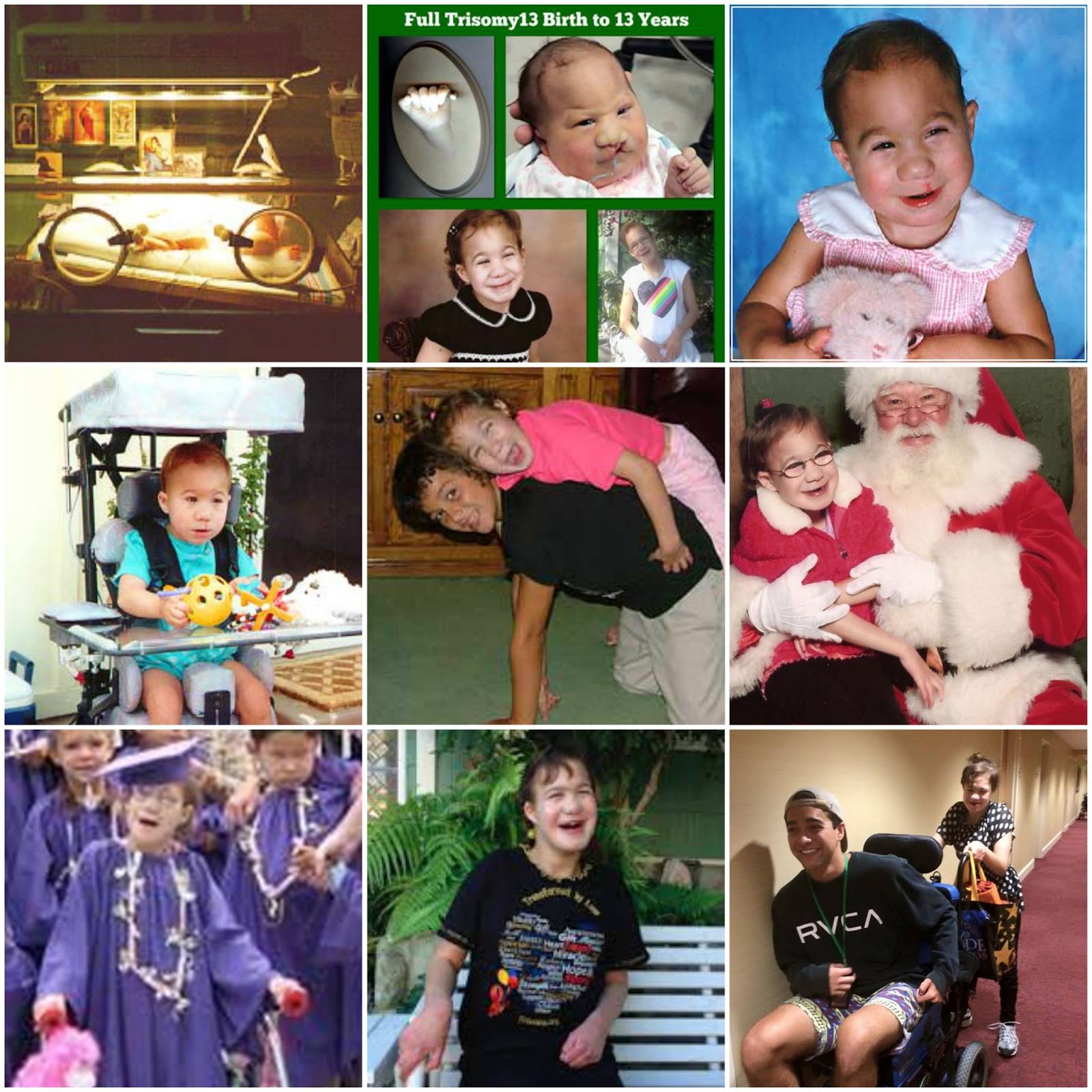 Trisomy 13 Life Expectancy