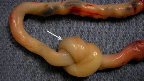 True Knot Umbilical Cord