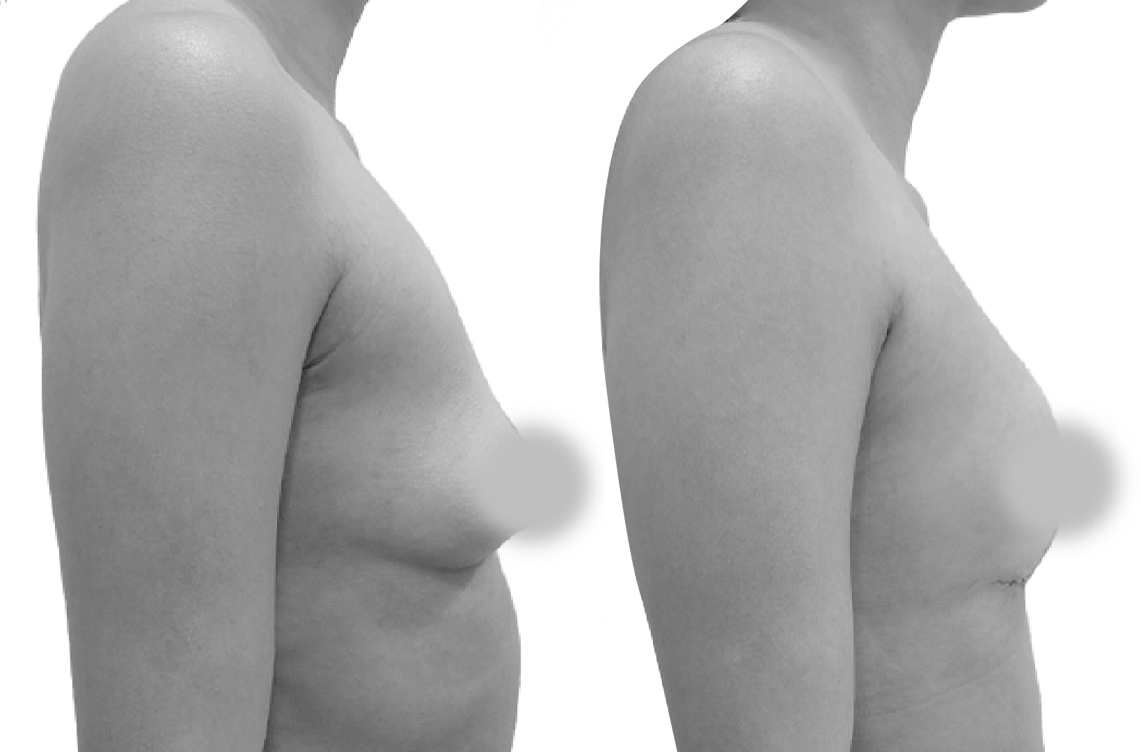 Tubular Breast Deformity