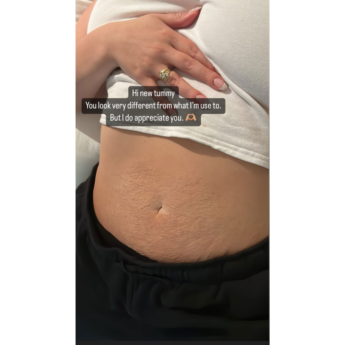 Tummy After Childbirth
