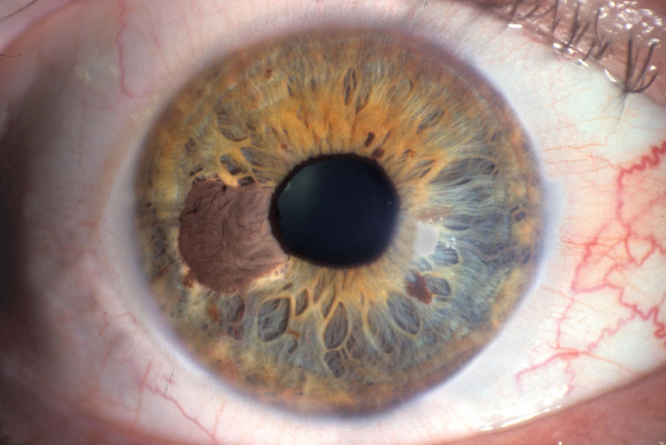 Tumor With Eyes