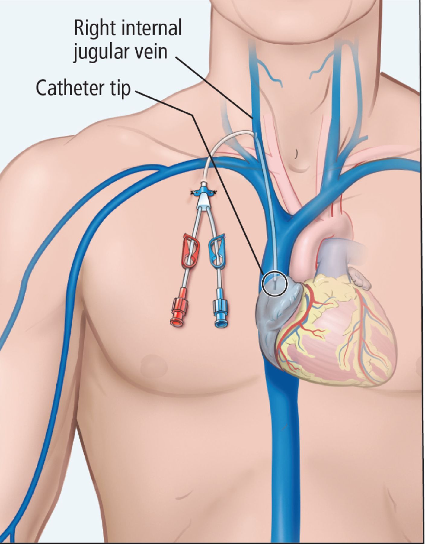 Tunneled Central Venous Catheter