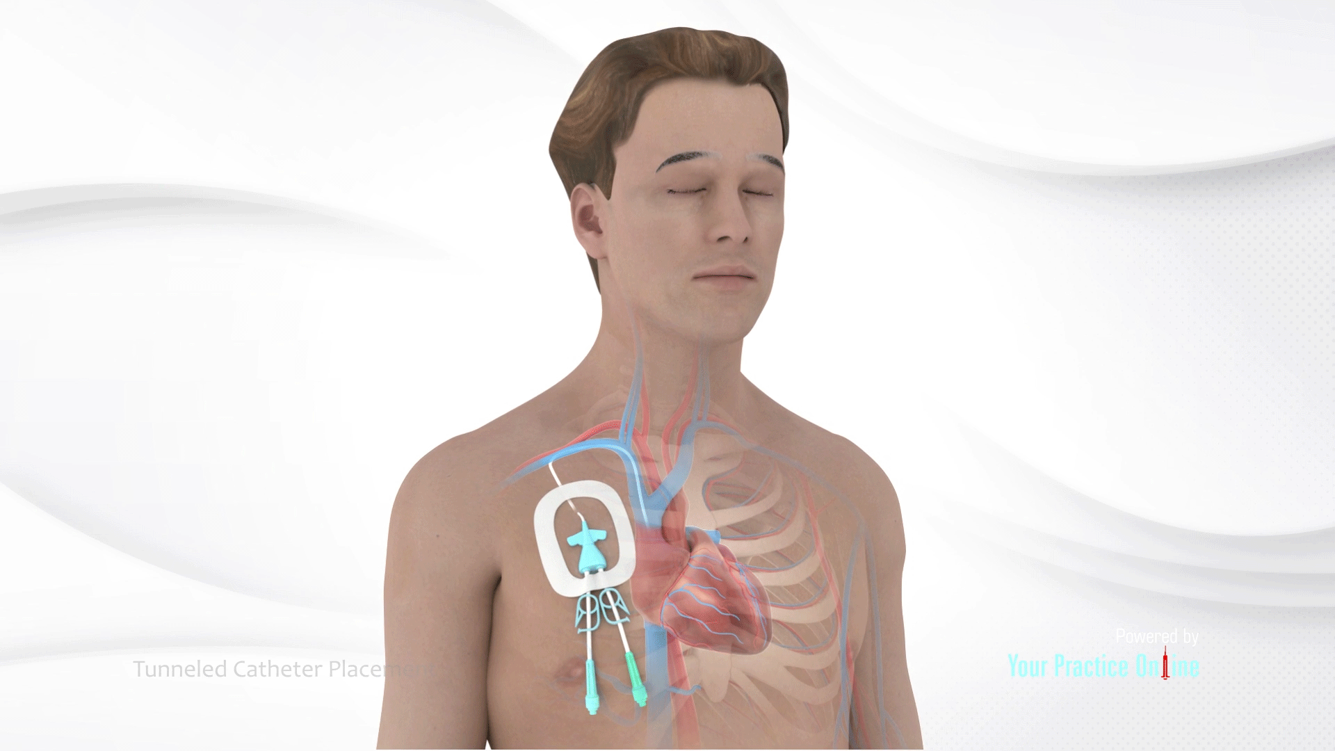 Tunneled Hemodialysis Catheter