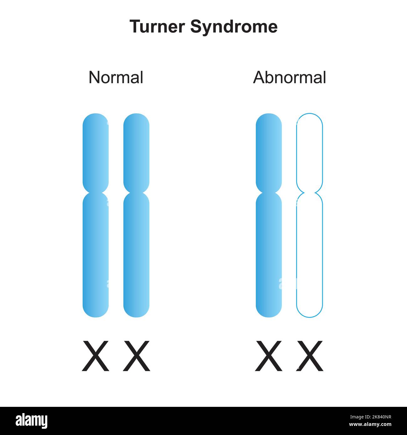 Turners Syndrome Monosomy