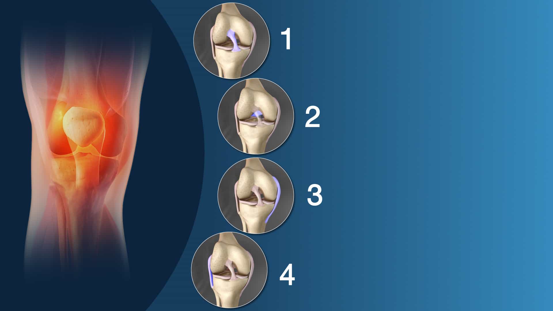 Twisted Knee Symptoms