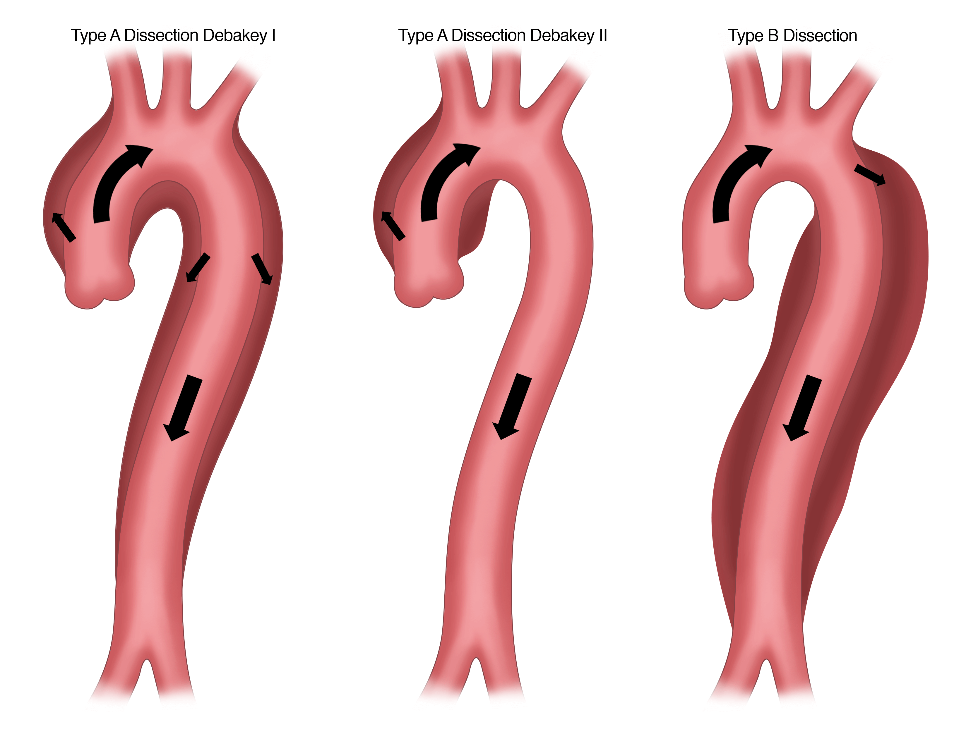 Type A Dissection