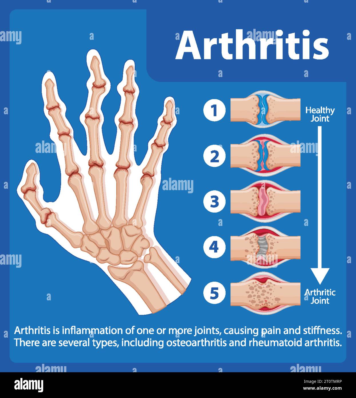 Types Of Arthritis In Hands