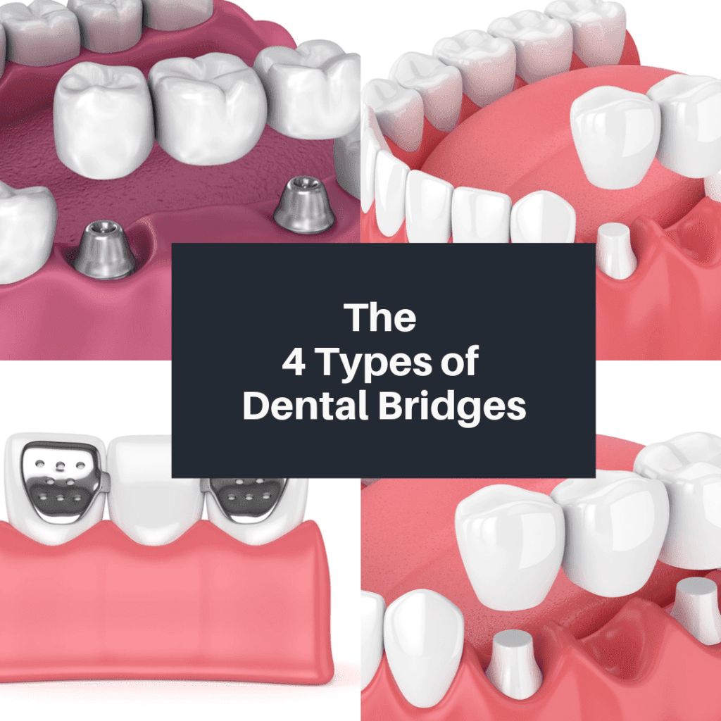Types Of Dental Bridges