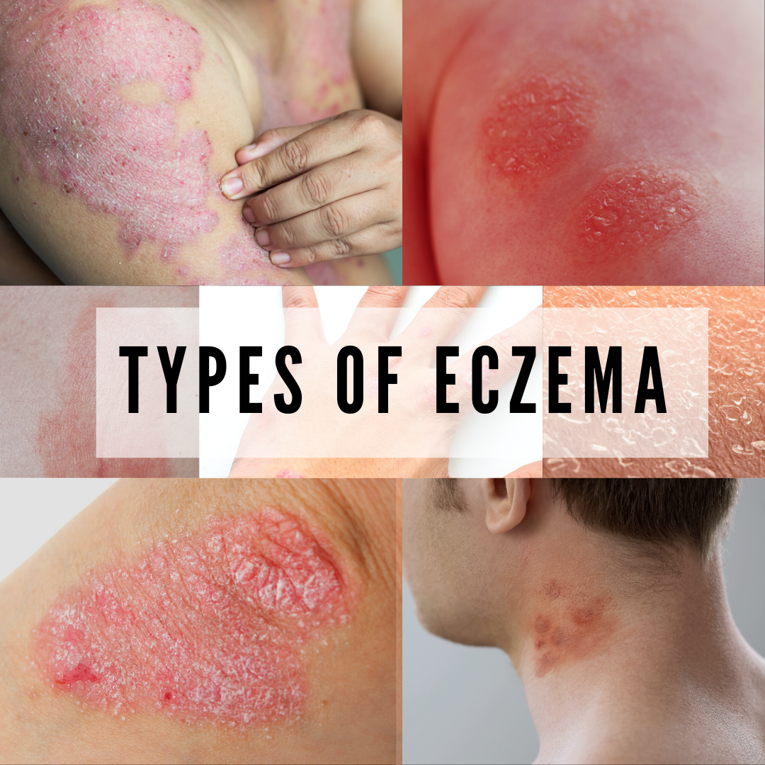 Types Of Eczema