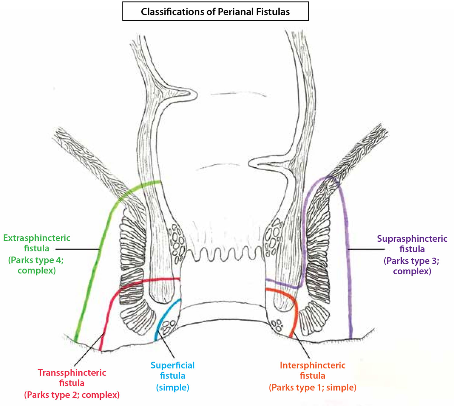 Types Of Fistula