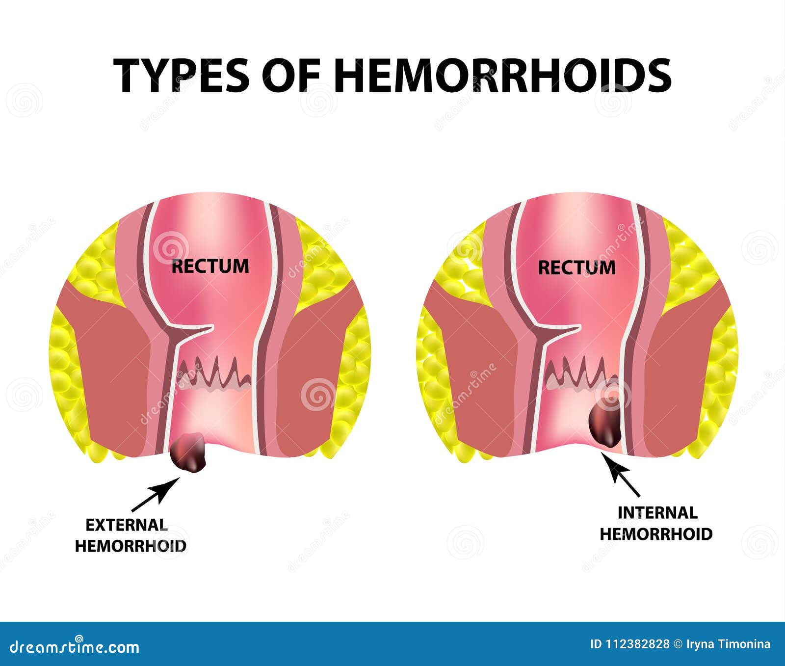 Types Of Hemorrhoids