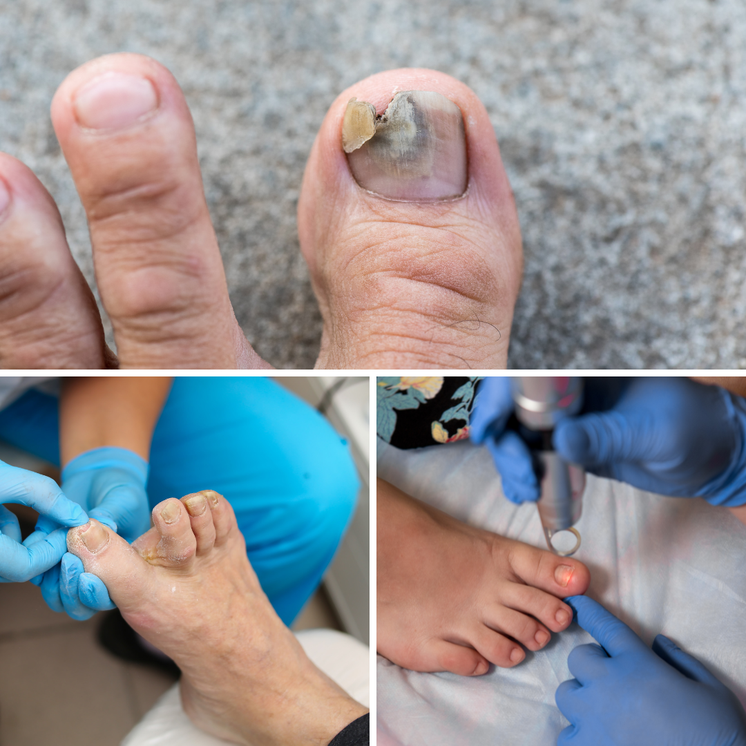 Types Of Toenail Fungus