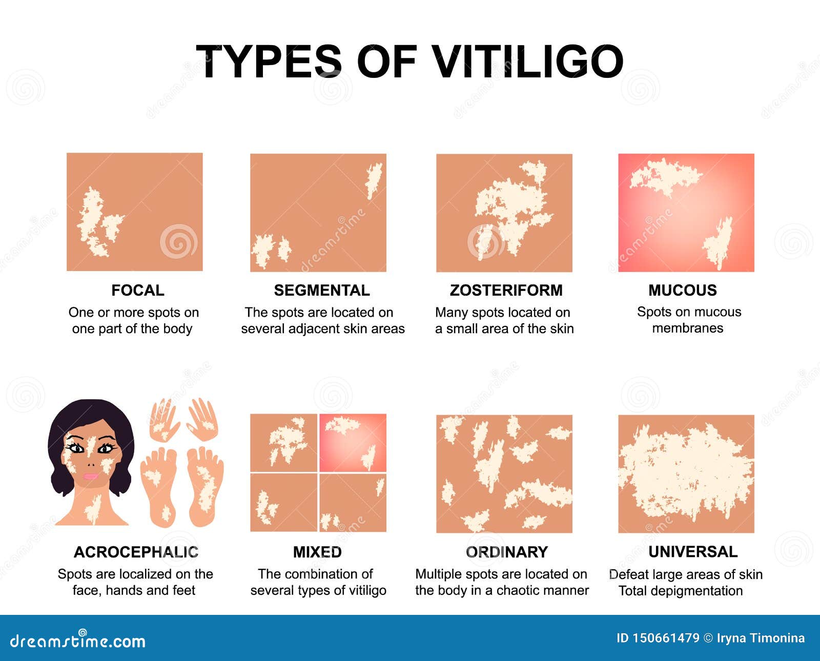 Types Of Vitiligo
