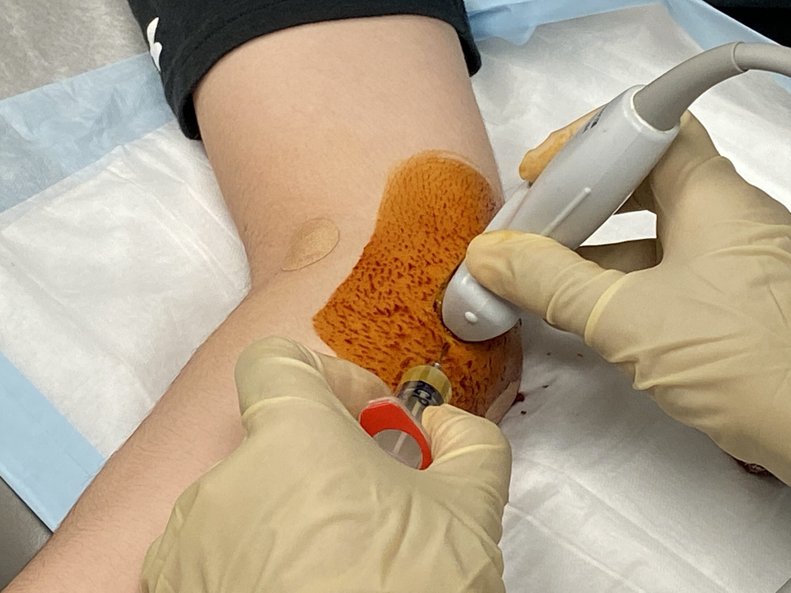 Ucl Tear Recovery Time