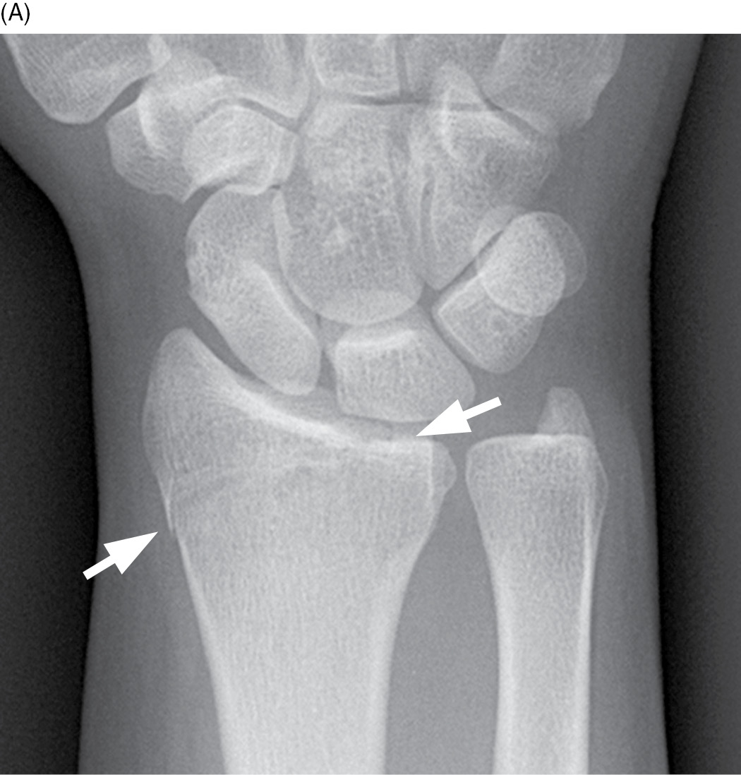 Ulnar Styloid Fracture