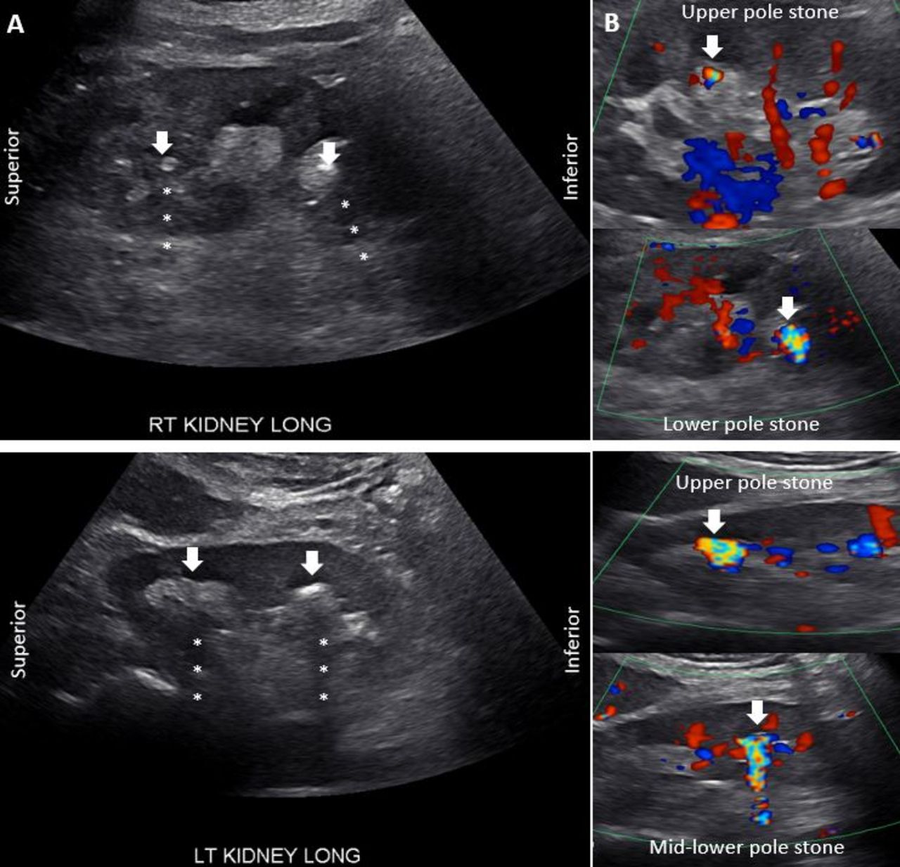 Ultrasound And Kidney Stones