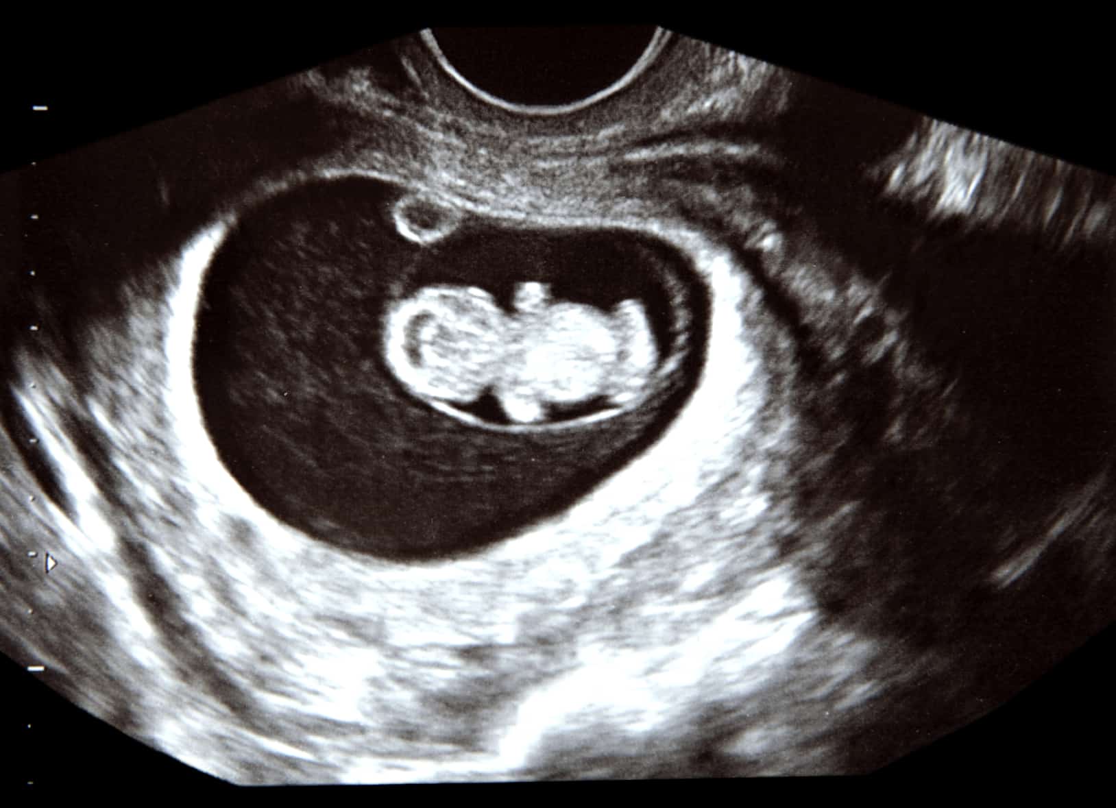 Ultrasound At 9 Weeks