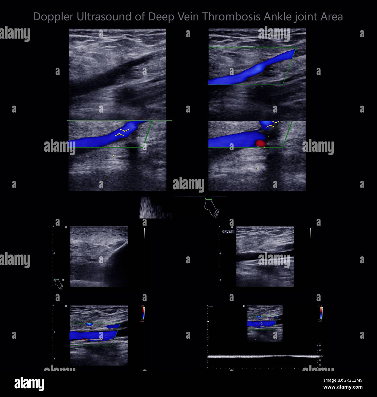 Ultrasound Deep Venous Thrombosis