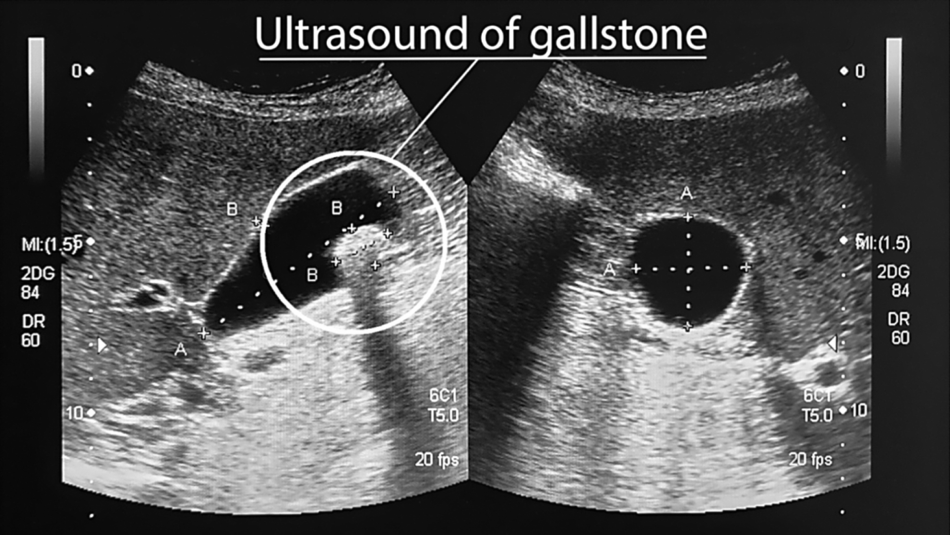 Ultrasound For Gallbladder Problems