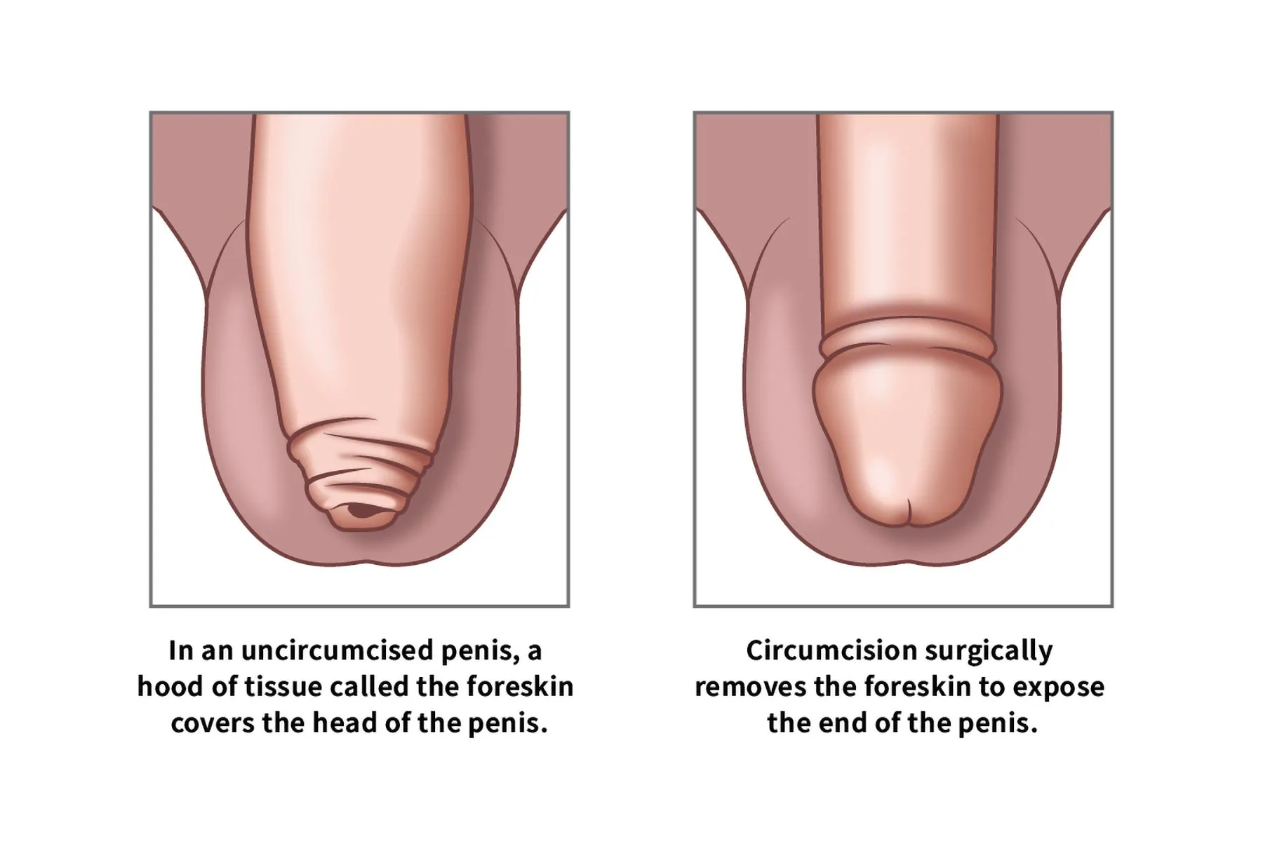 Uncircumcised And Circumcised
