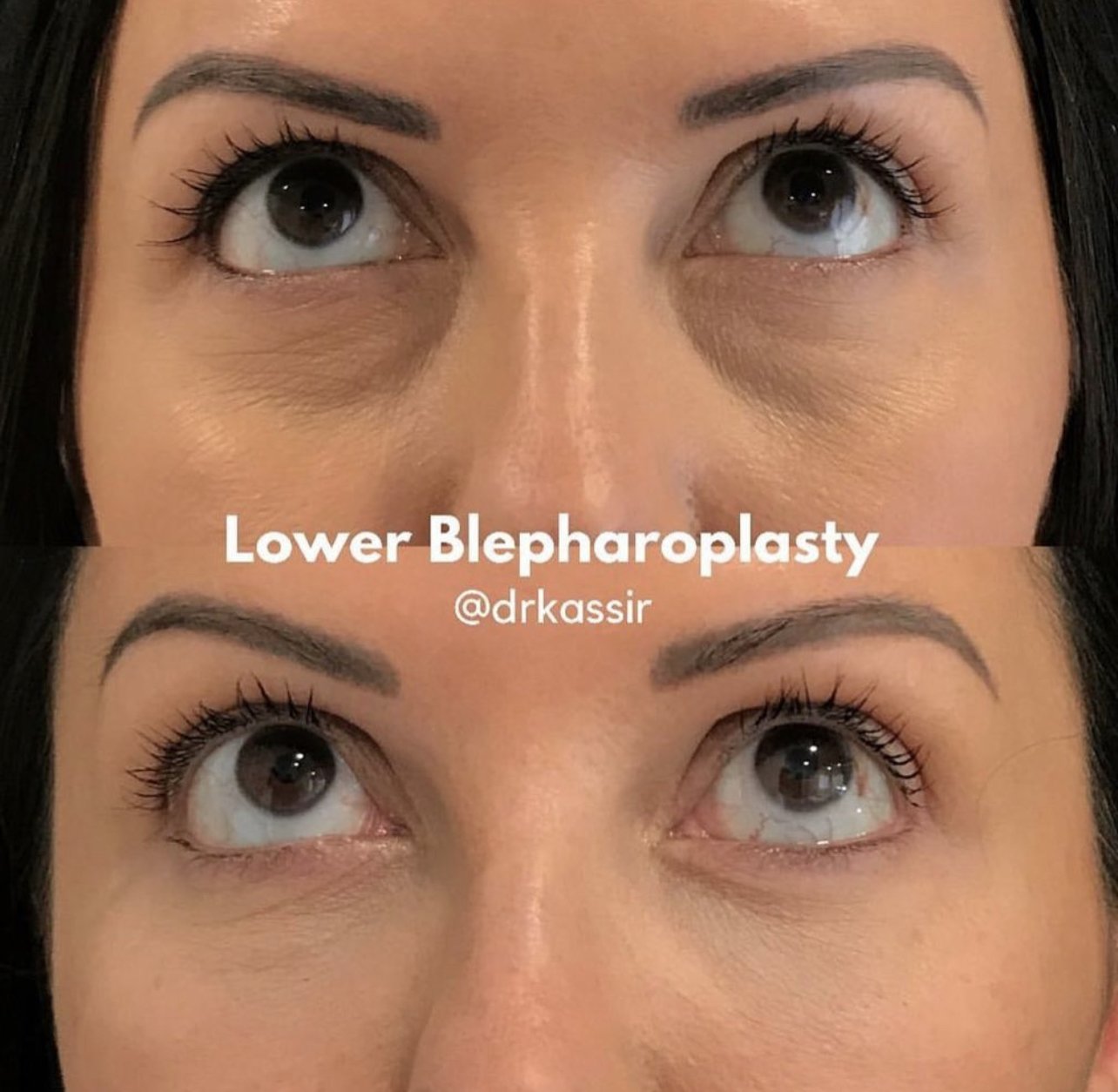Under Eye Surgery