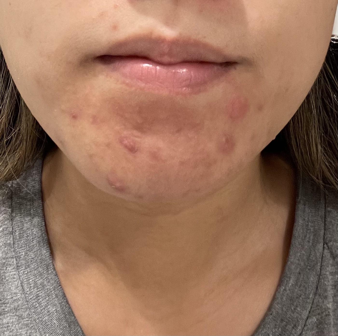Under Skin Spots On Chin