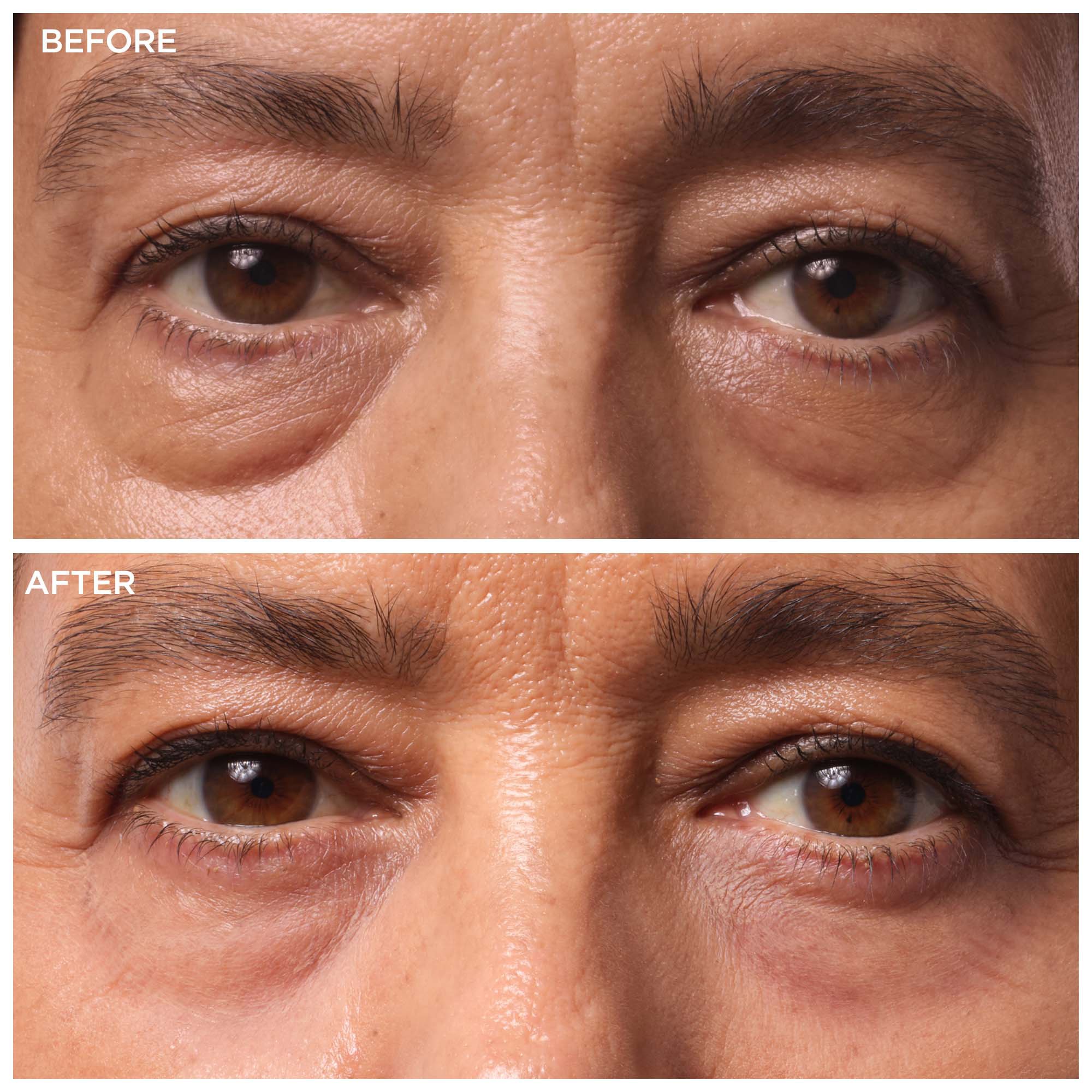 Under The Eye Bags Treatment