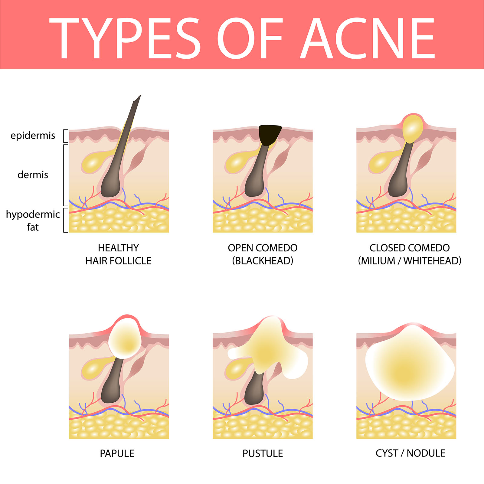 Under The Skin Pimple