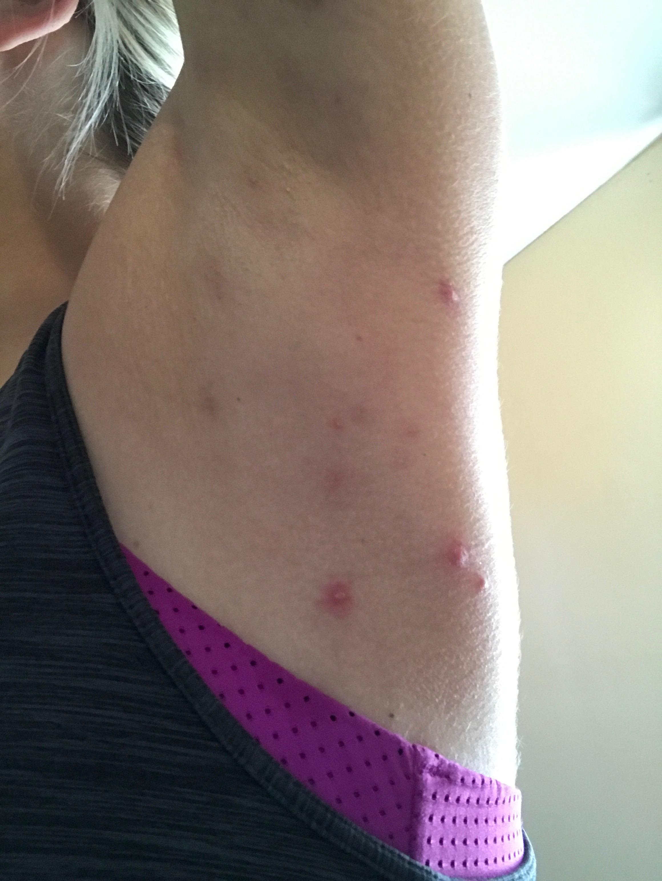 Underarm Lumps Pictures