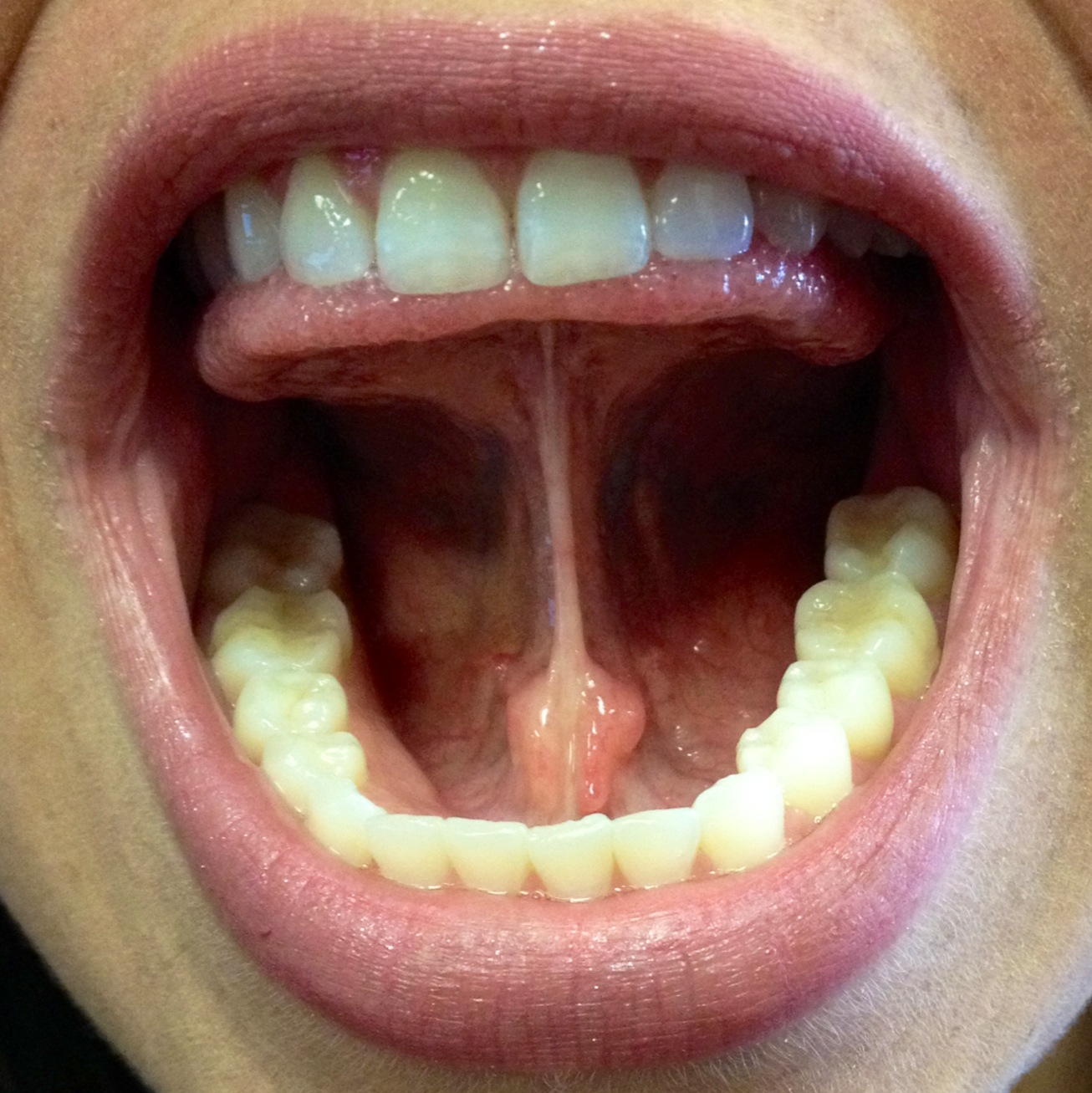 Upper Lip Frenulum
