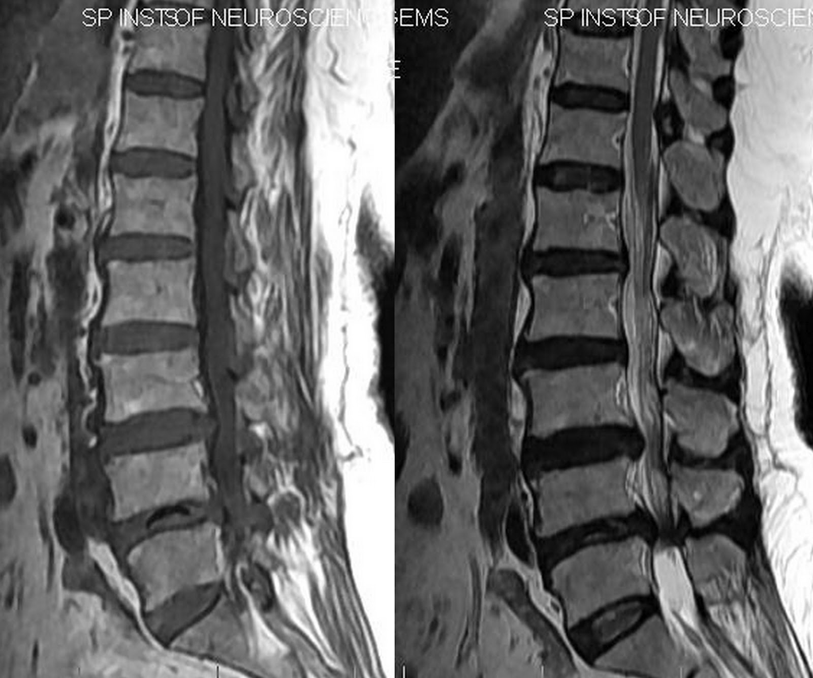 Vacuum Disc Phenomenon