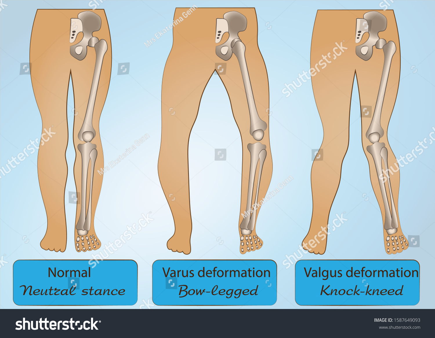 Valgus Vs Varus