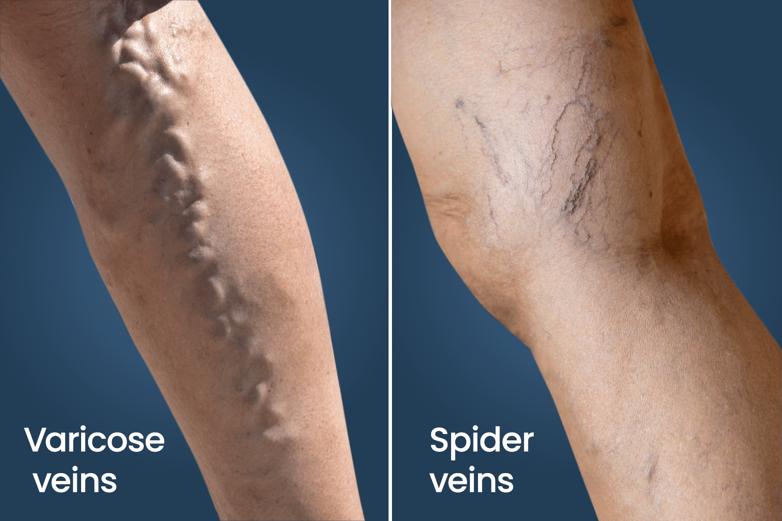 Varicose Veins Vs Spider Veins