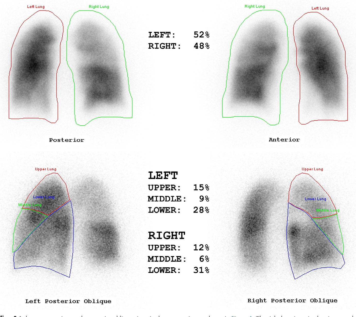 Ventilation Perfusion Scan