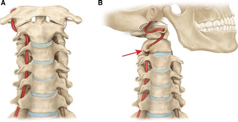 Vertebral Artery Occlusion