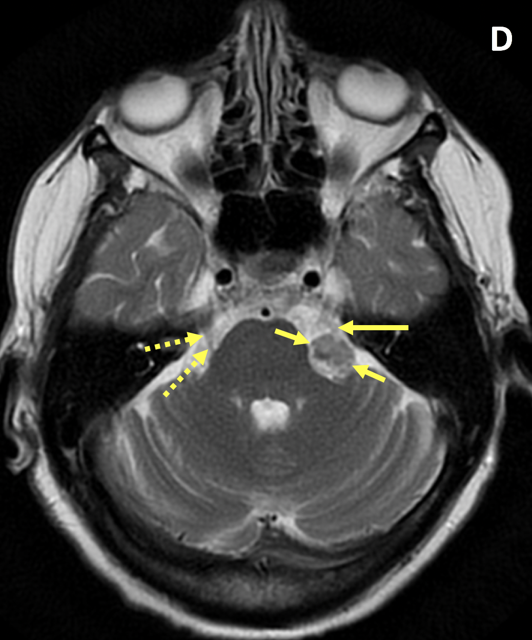Vestibular Schwannoma Mri