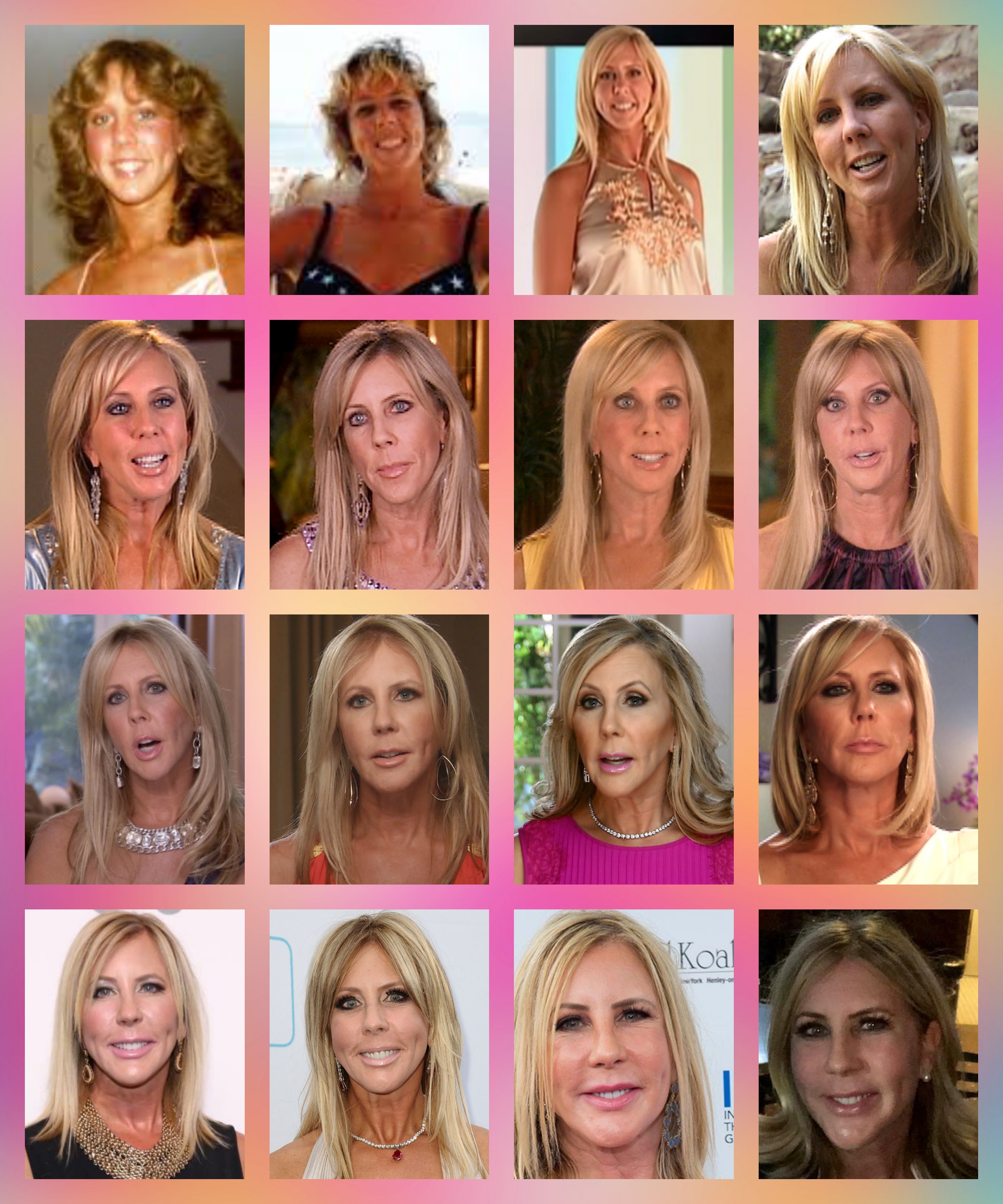 Vicki Gunvalson Face Surgery