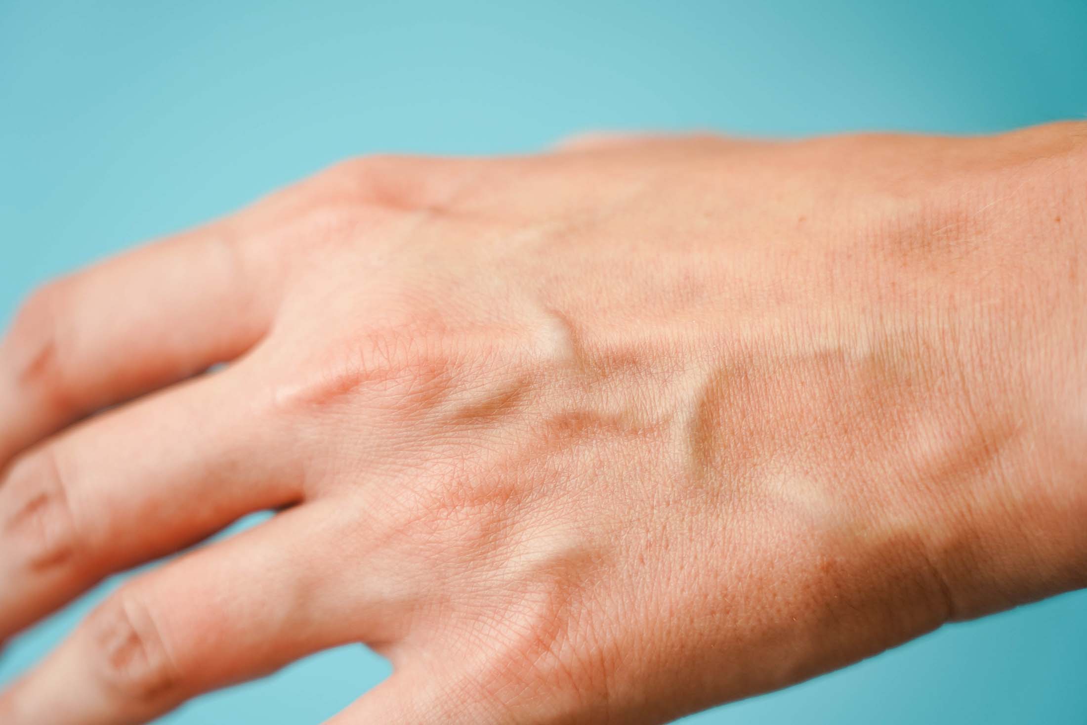 Visible Veins In Hands