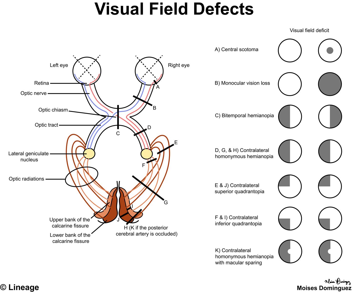 Visual Field Defects