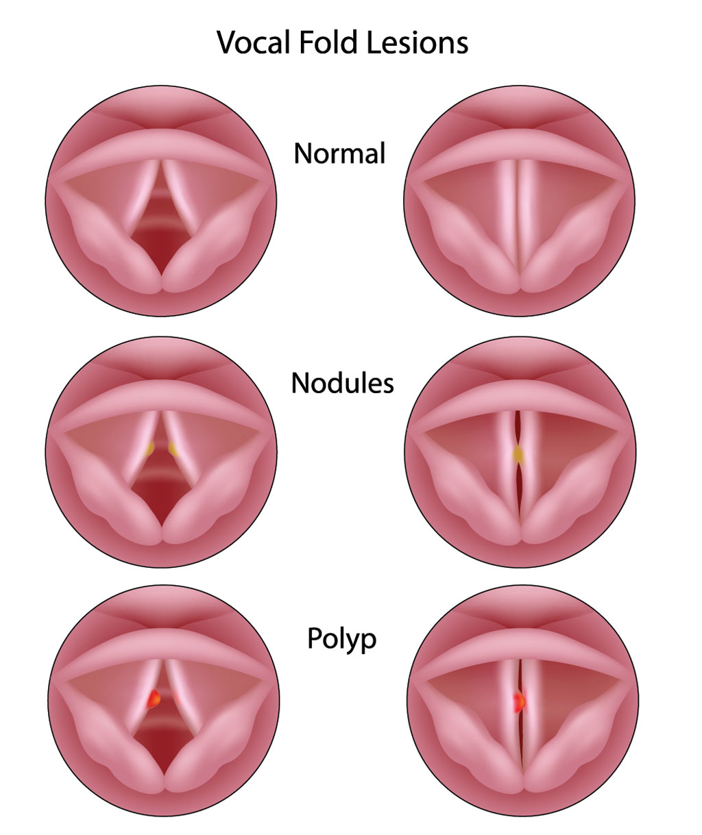Vocal Cord Nodules Polyps