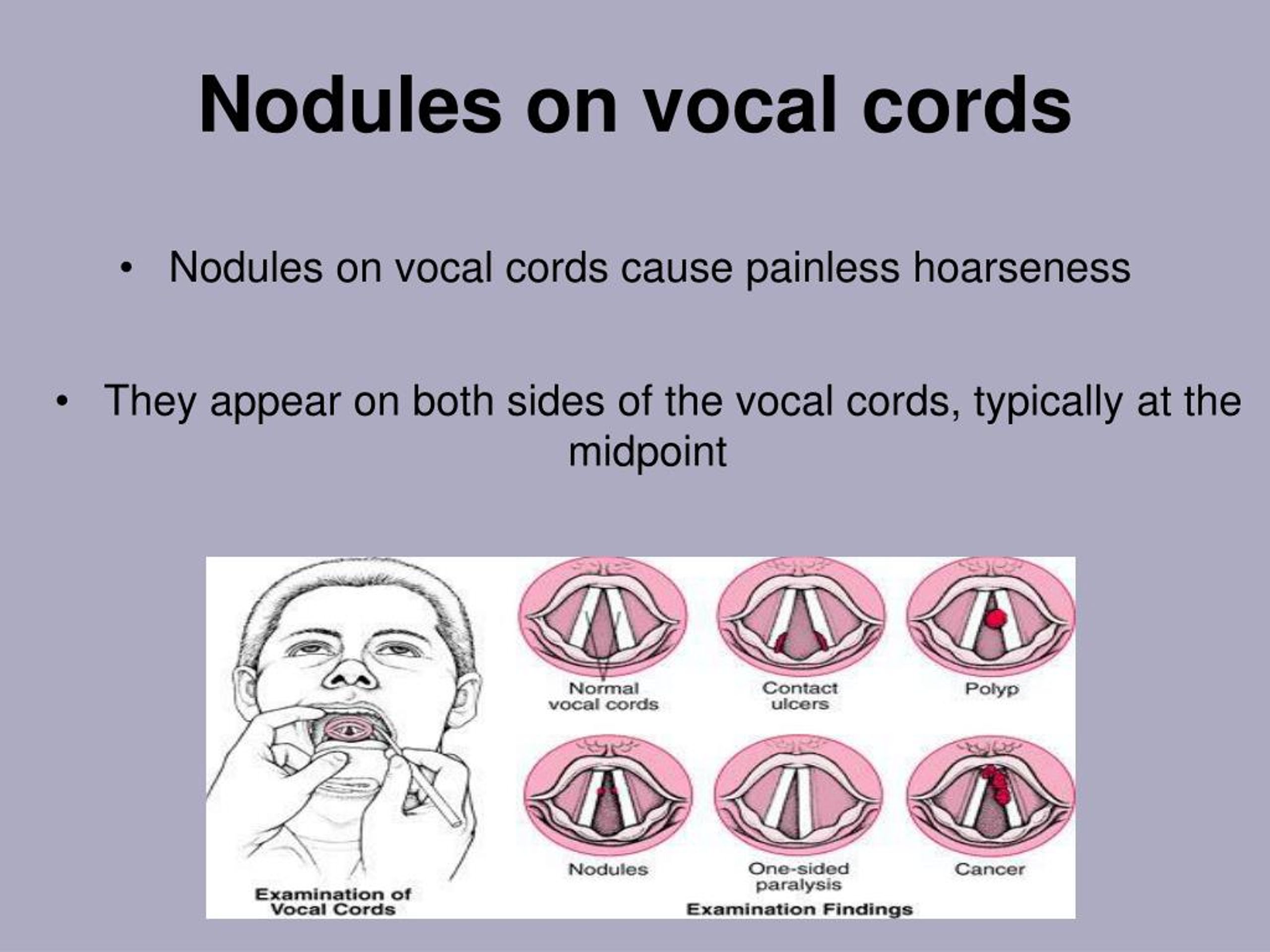 Vocal Nodules Symptoms