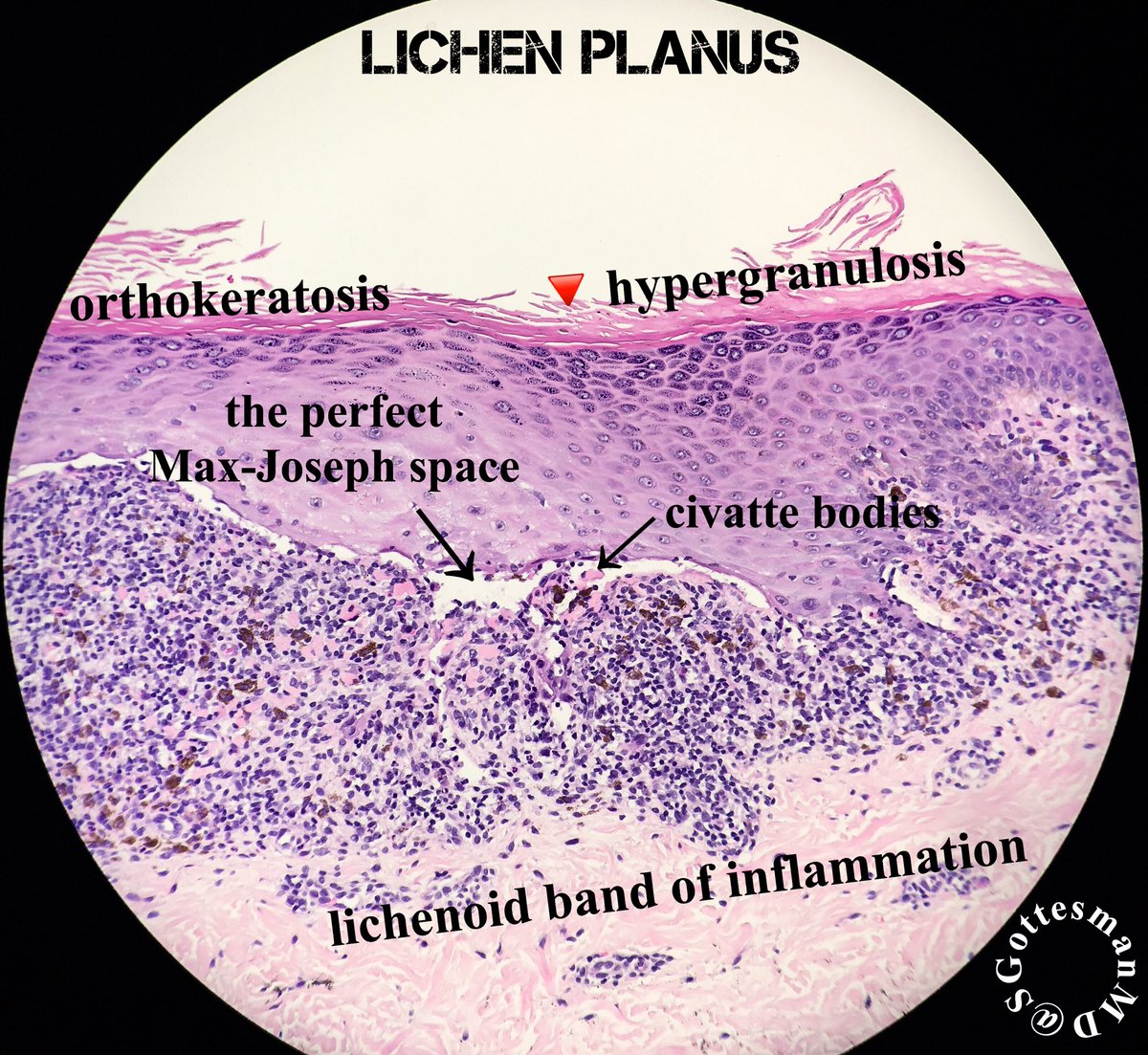 Vulvar Lichen Planus