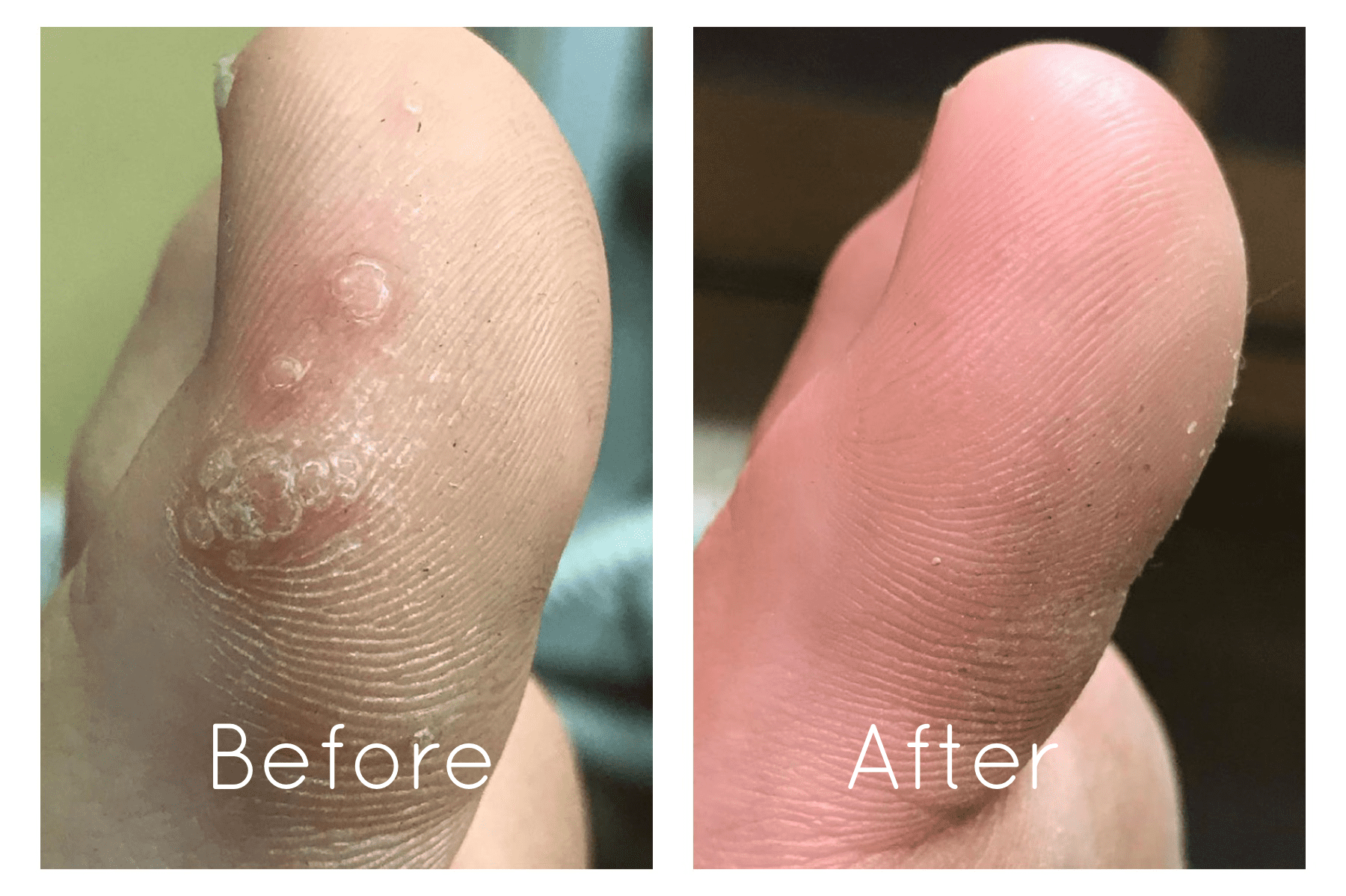 Wart Between Toes