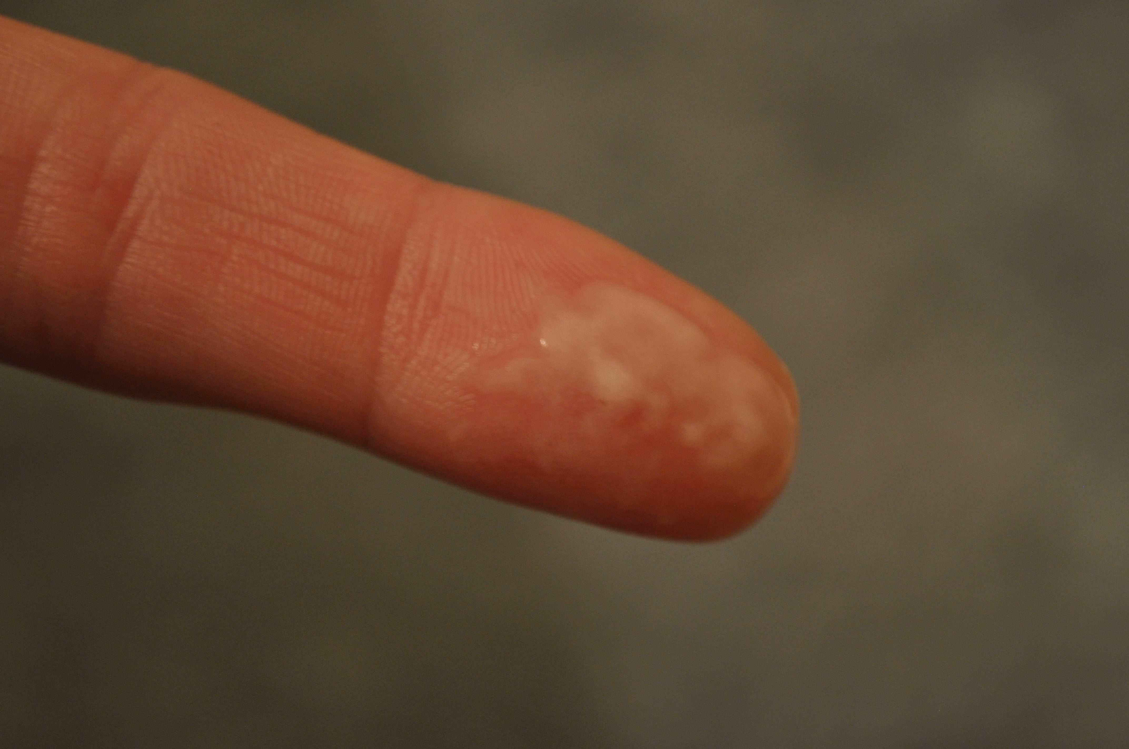 Watery Discharge Before Period